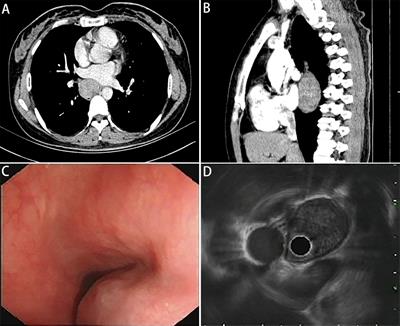 Identification of a novel FGFR2-KIAA1217 fusion in esophageal gastrointestinal stromal tumours: A case report